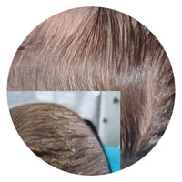 Cradle cap in a six-month-old baby