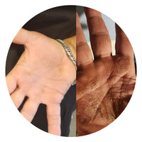 Y.S – Diagnosed with Psoriasis.